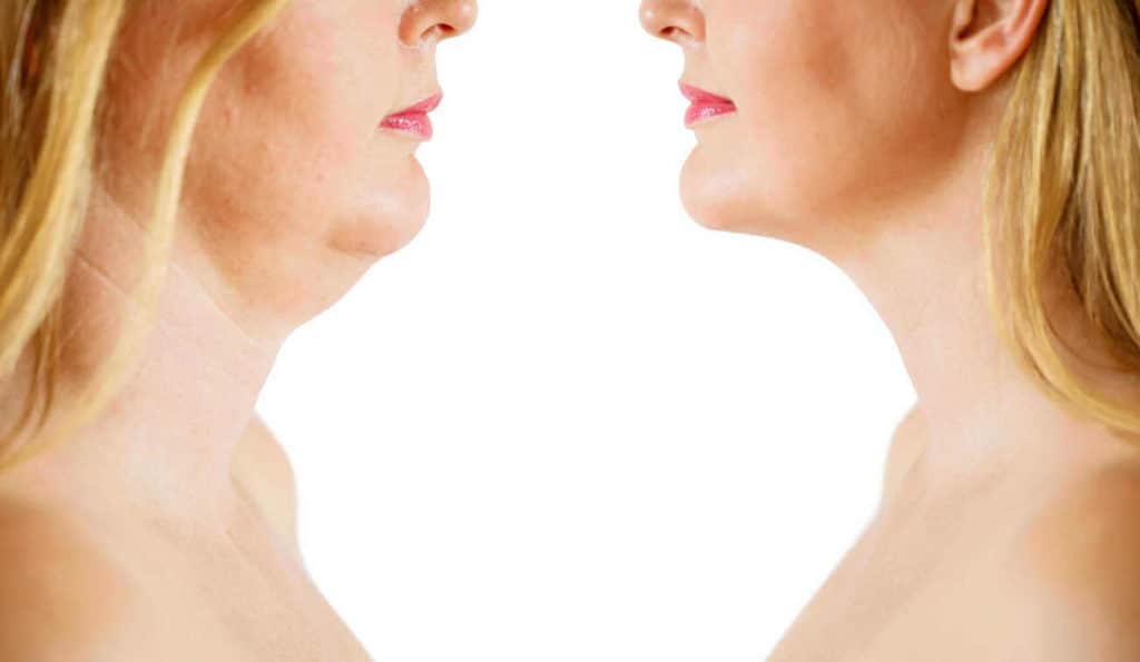 Double Chin treatment Northamptonshire before and after results