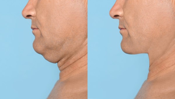 Which Non-Surgical Treatments Work Best for Jowls and Loose Skin Northamptonshire?