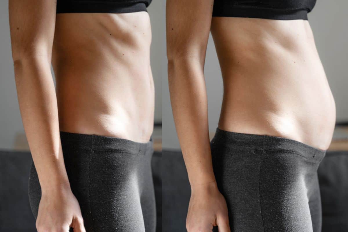 How long does diastasis recti take to improve Northamptonshire?