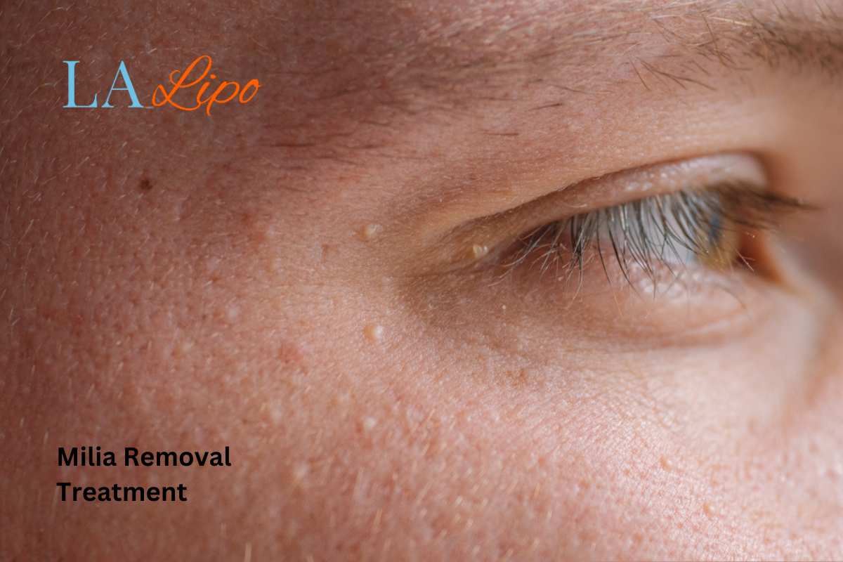 Cryopen Milia Removal: Is It the Easiest and Safest Option Northamptonshire?