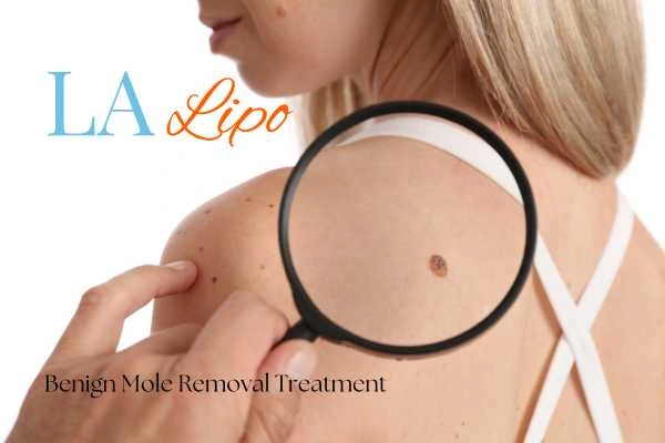 Why getting moles removed Northamptonshire can boost your confidence!