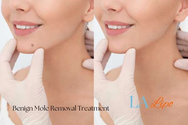 woman's before and after mole removal Northamptonshire results