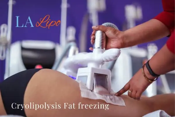 women getting fat freezing Northamptonshire
