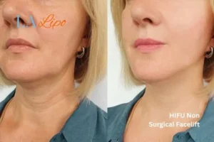 hi-fu for wrinkles Northamptonshire before and after results