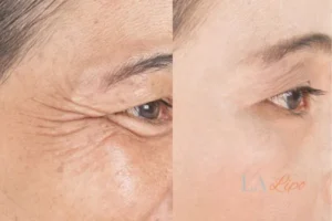 Before and after results of woman - HI-fu wrinkles reduction treatment Northamptonshire