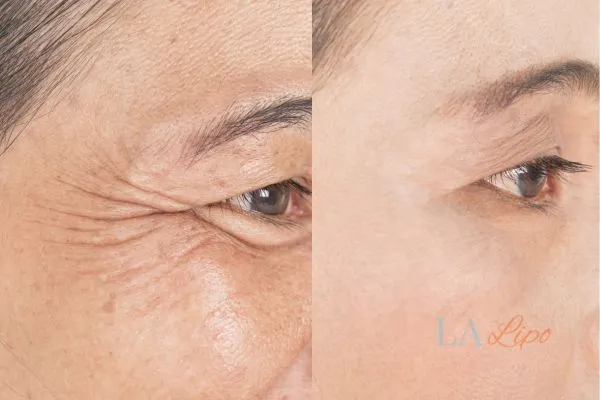 Before and after results of woman - HI-fu wrinkles reduction treatment Northamptonshire