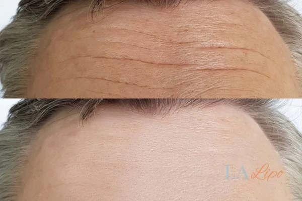 results of HIFU Northamptonshire on mans forehead to help reduce lines and wrinkles
