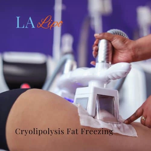 fat freezing - Cryolipolysis Northamptonshire