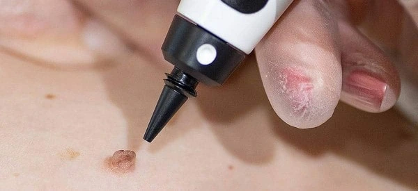 skin tag removal using cryopen Northamptonshire