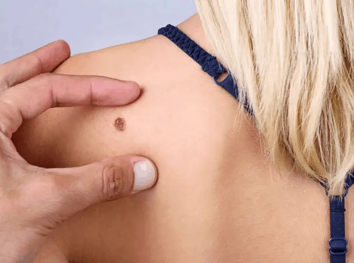 woman having mole removal Northamptonshire consultation before treatment.