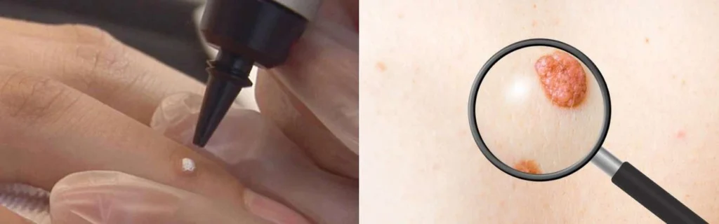 Person getting moles removed with cryopen Northamptonshire