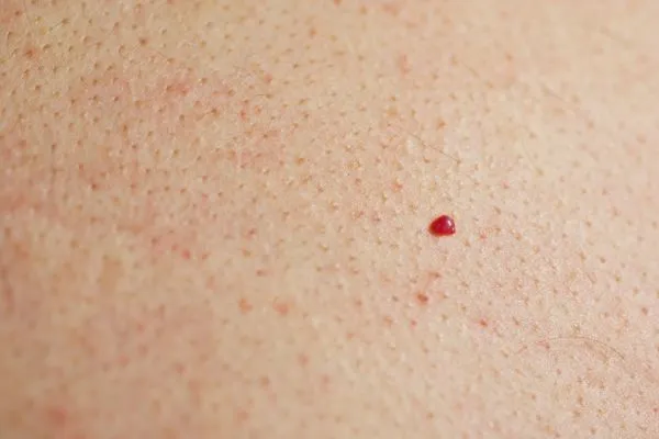 close up of a cherry angioma Northamptonshire