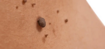 image of a skin tag Northamptonshire