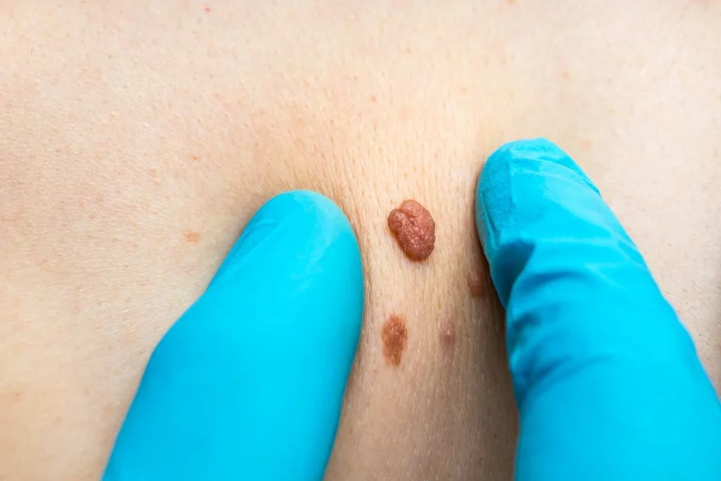 Consultant examining a skin tag Northamptonshire