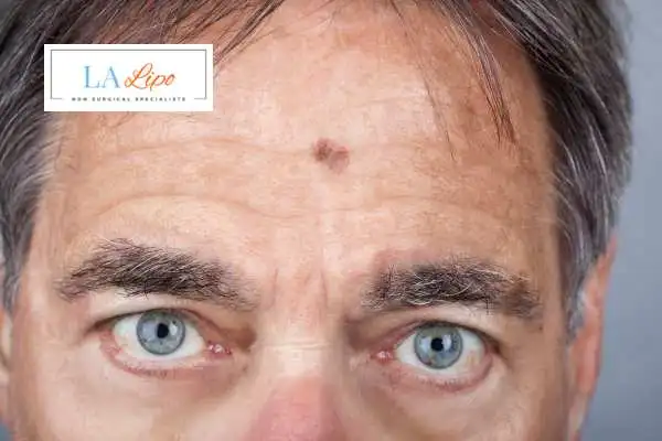 Solar Lentigo Removal Northamptonshire image of man with mark on his forehead