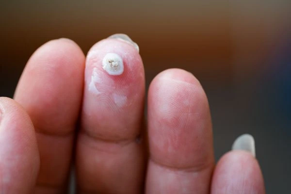 wart on person finger - cryotherapy to treat from LA LIPO Northamptonshire