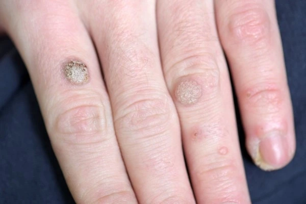 photo of warts on person hand - see wart removal Northamptonshire from LA LIPO