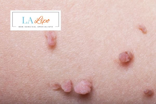 Does cryopen skin tag removal Northamptonshire hurt? Find out now call our team today!