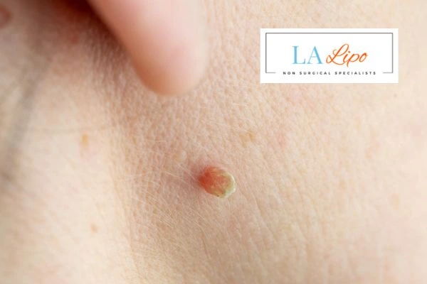 Book skin tag removal Northamptonshire today speak to our team now!