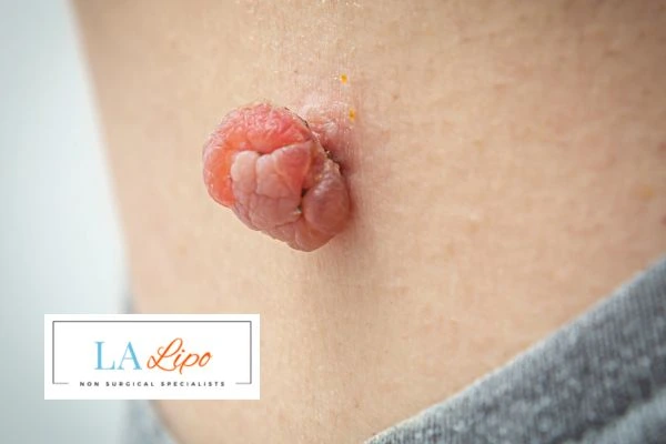 Interested in skin tag removal Northamptonshire? Concerned about the pain? Find out more today!