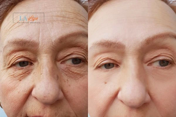 The powerful benefits of Morpheus8 Treatment Northamptonshire - Call Our team today!