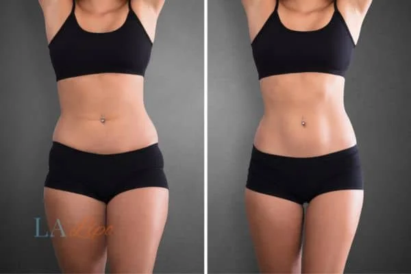 before and after results of non-surgical treatment to help a woman's body image and mental health Northamptonshire