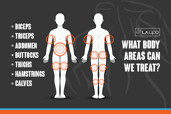 Diagram to show areas you can have LA-EMS Body Sculpting Treatment Northamptonshire