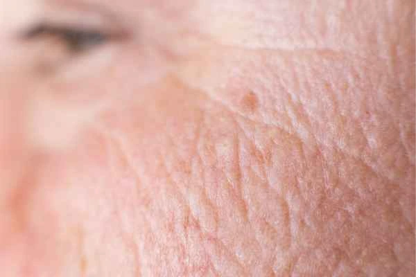 close up picture of a woman's face showing an age spot Northamptonshire