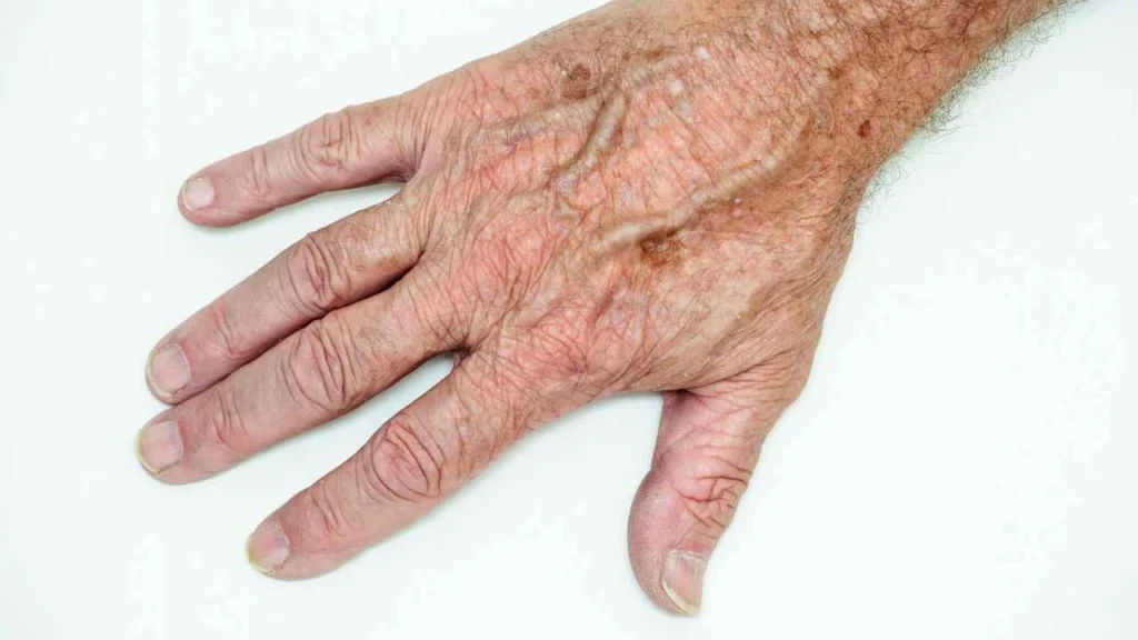 Male hand showing age spot Northamptonshire