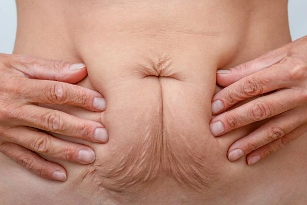 Image of a woman's stomach with loose skin - example of skin tightening Northamptonshire options