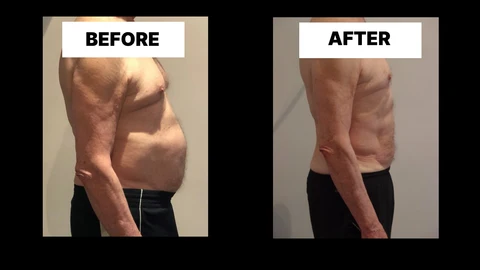 What Symptoms Can Diastasis Recti Cause in Men? Weak Core, Back Pain and Poor Posture Northamptonshire